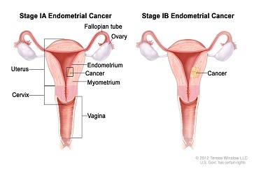Uterine cancer treatment in ahmedabad